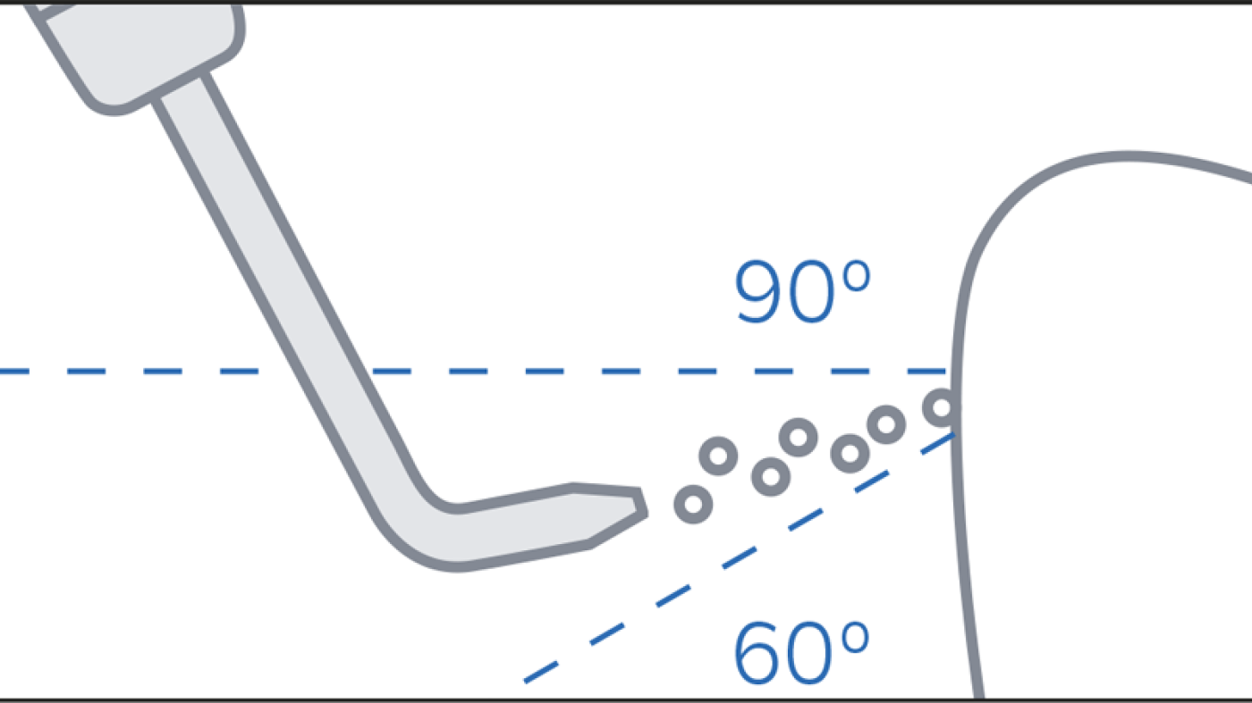 Supragingival